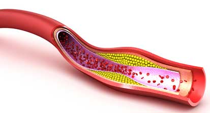 Arterienverkalkung - Arteriosklerose