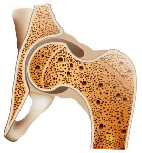 Erkrankungen der Knochen, Osteoporose, Knochen-Krankheiten, Kalziummangel